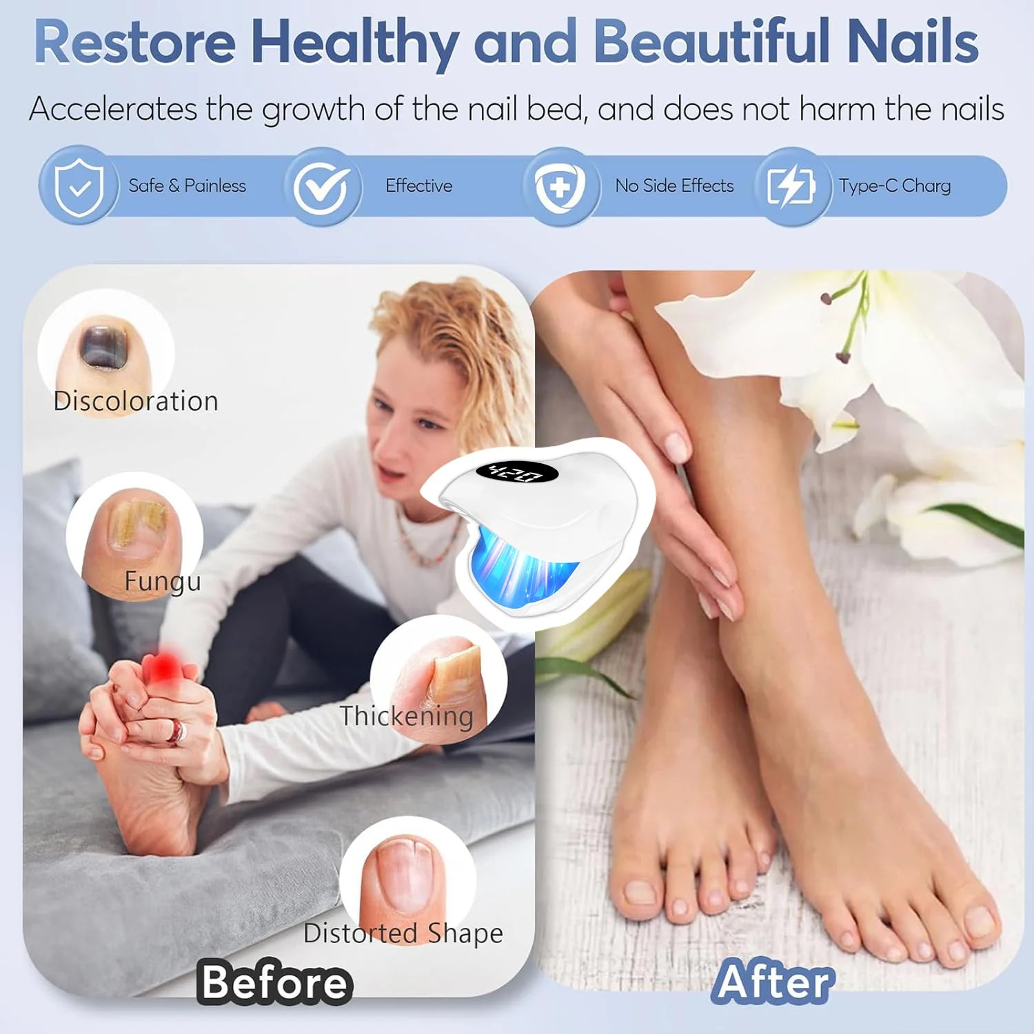 Nail Fungus Laser Device 500NM Blue Light + 940NM Infrared Laser - Wireless Cold Therapy for Onychomycosis Toenail Fingernail Ca