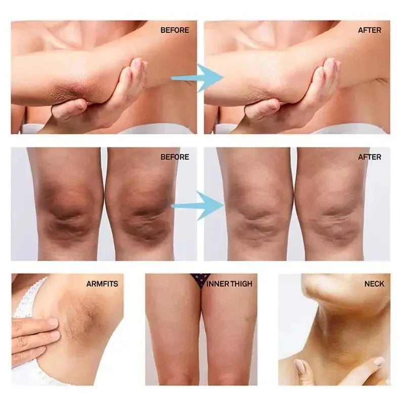 Body Whitening Cream Private Parts Underarm Knee Thigh Inner Melanin Bleaching Brighten Lotion Dark Skin Healthy White Body Care